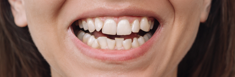 Diamond Invisalign Provider 2025 AP Dental Boston Florida Before